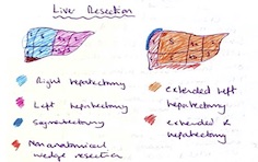 Liver resection